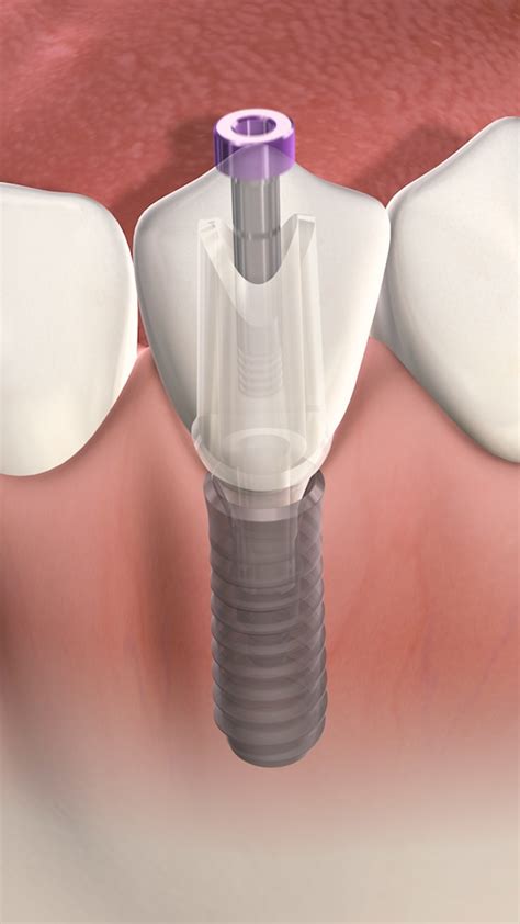 dental in okc oklahoma implants